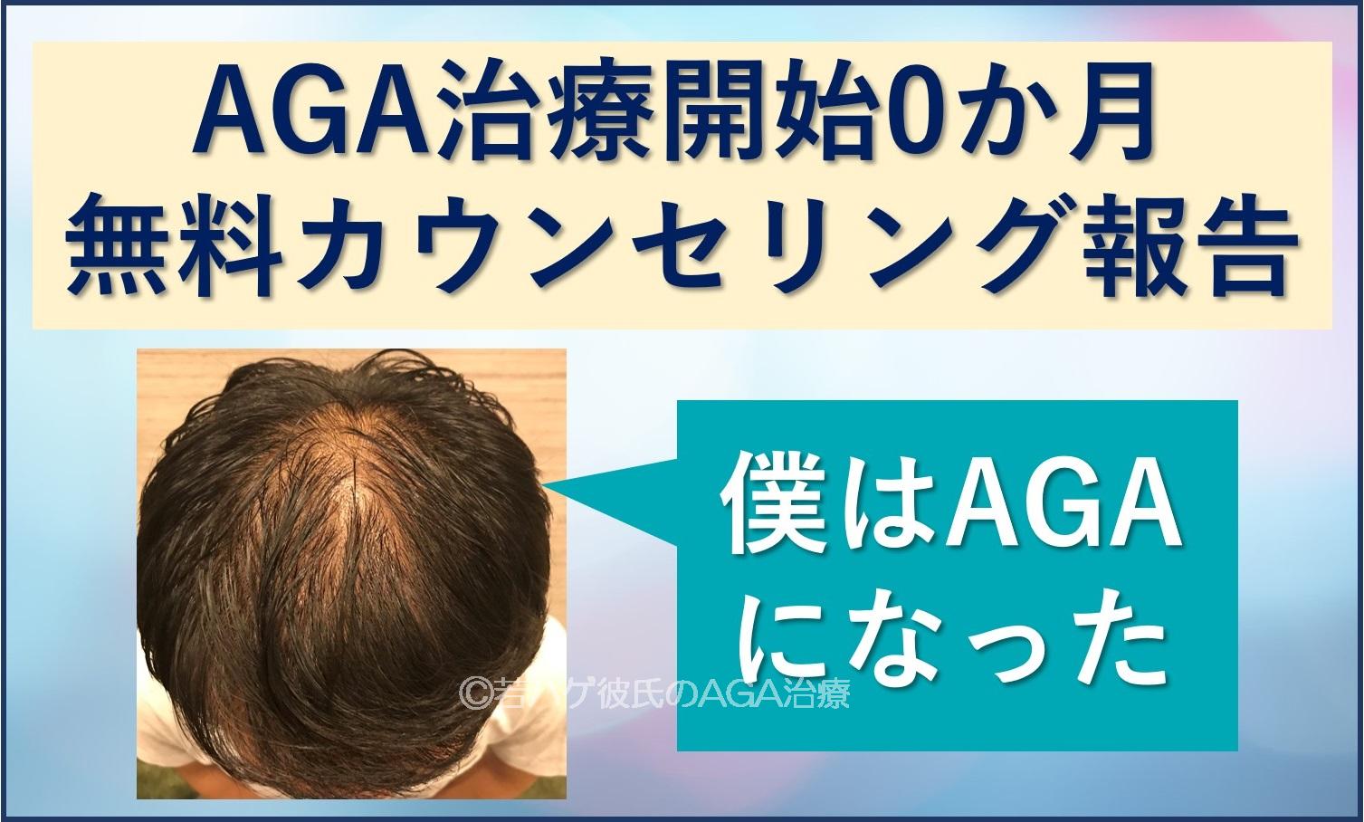 AGA治療開始0か月
