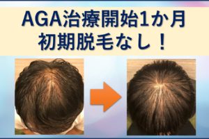 AGA治療1か月目、初期脱毛無し