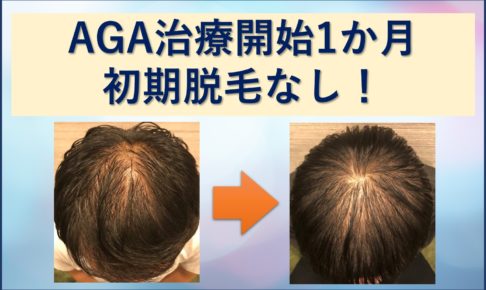 AGA治療1か月目、初期脱毛無し