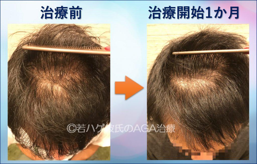 AGA治療1か月TOP