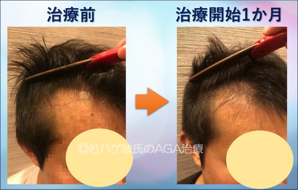 AGA治療1か月サイド