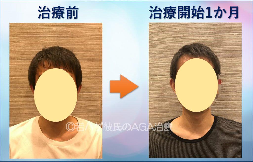 AGA治療1か月正面
