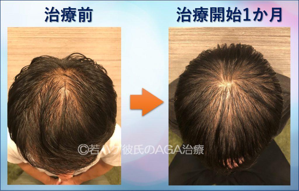 AGA治療1か月目の頭頂部