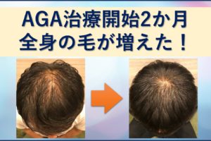 AGA治療2か月目で全身の毛が増えた