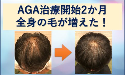 AGA治療2か月目で全身の毛が増えた
