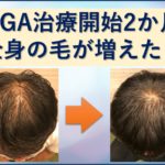 AGA治療2か月目で全身の毛が増えた