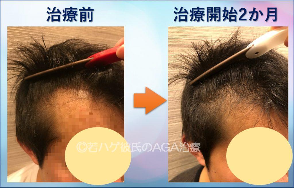AGA治療2か月サイド
