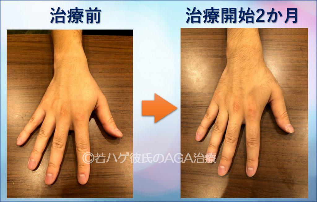 AGA治療2か月手