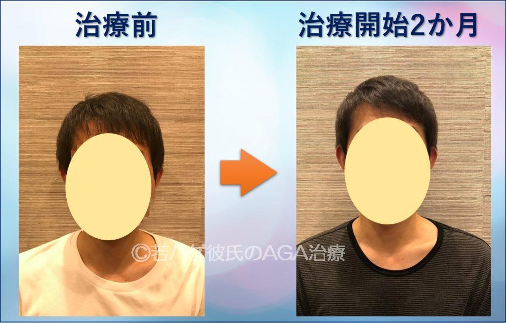 AGA治療2か月正面