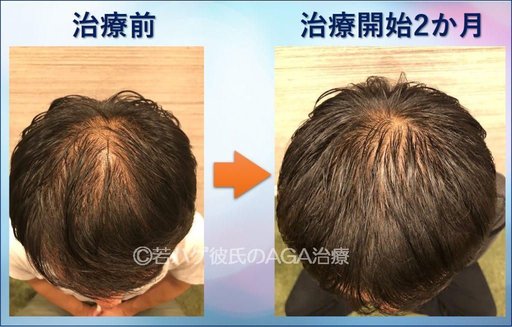 AGA治療2か月