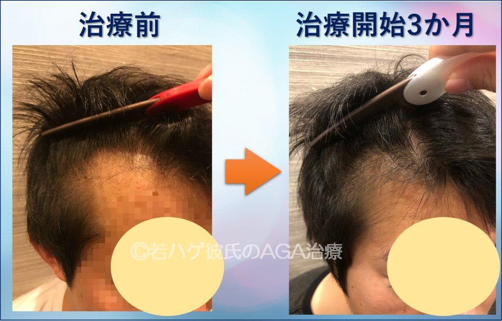 AGA治療3か月サイド