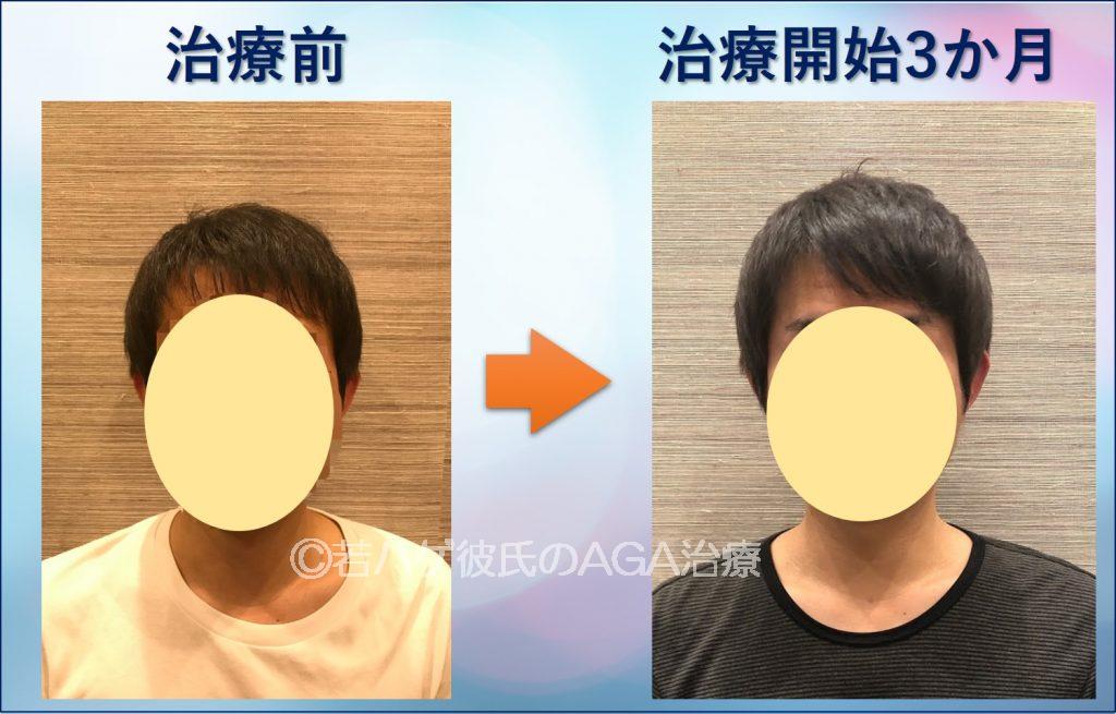 AGA治療3か月正面