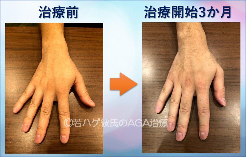 AGA治療3か月手