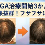 AGA治療3か月ミノタブで生えすぎ