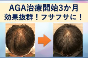 AGA治療3か月ミノタブで生えすぎ