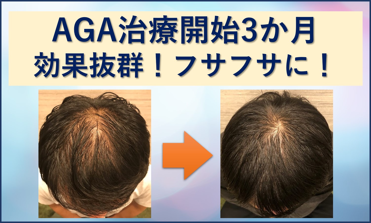 AGA治療3か月ミノタブで生えすぎ