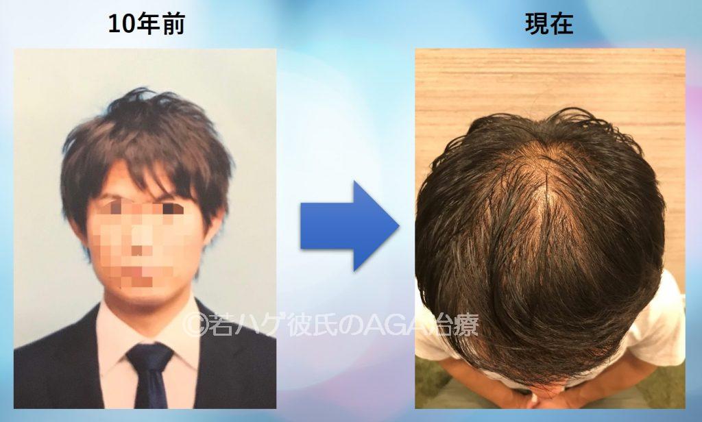 ほしみみ彼氏の毛量激減