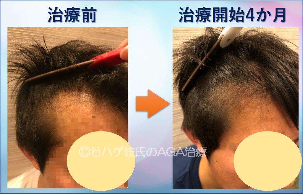 AGA治療4か月目のサイド