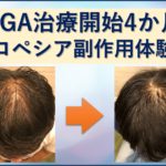 プロペシア副作用体験談