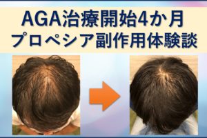 プロペシア副作用体験談