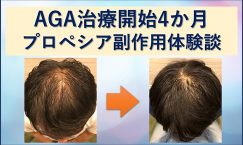 プロペシア副作用体験談