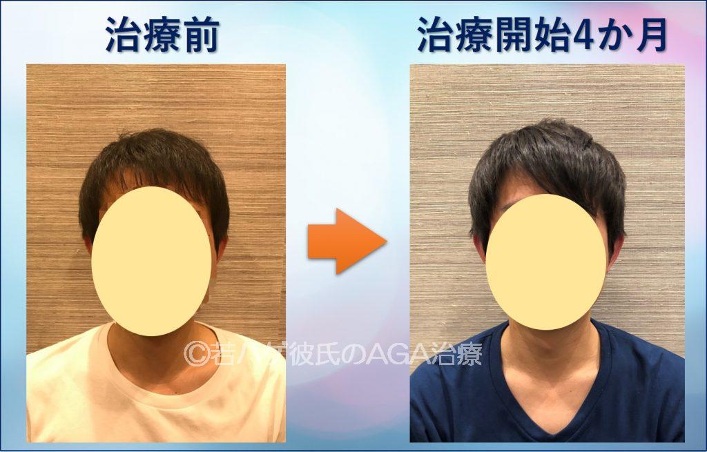 AGA治療4か月の正面