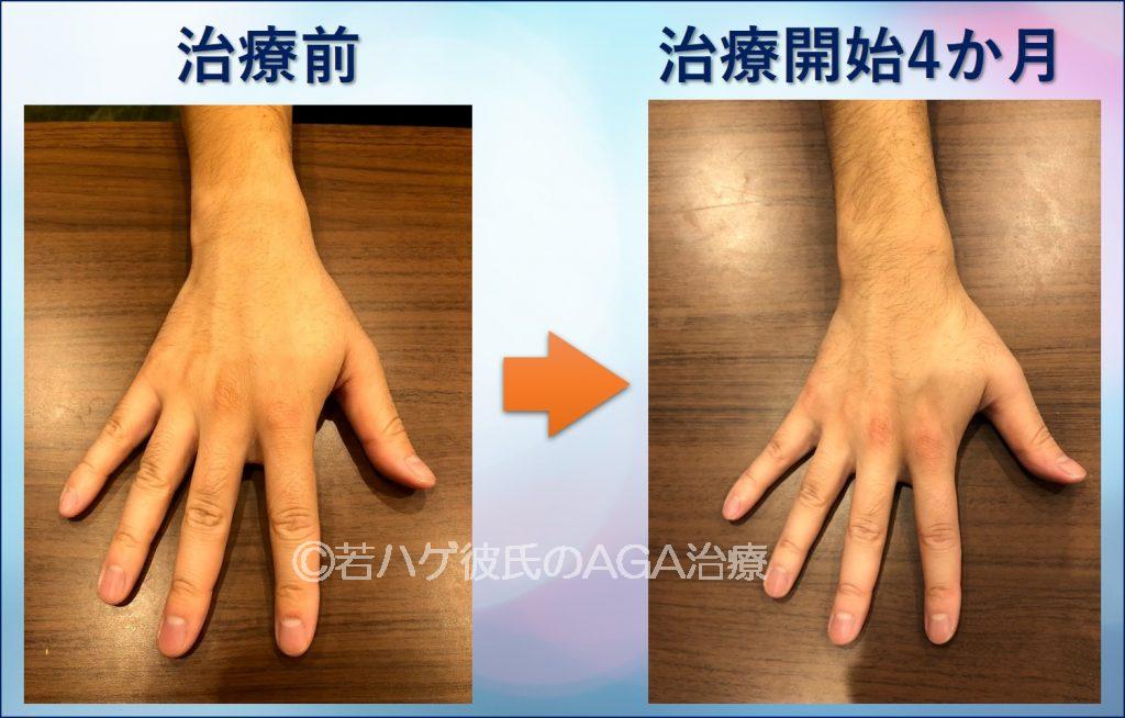AGA治療4か月の腕