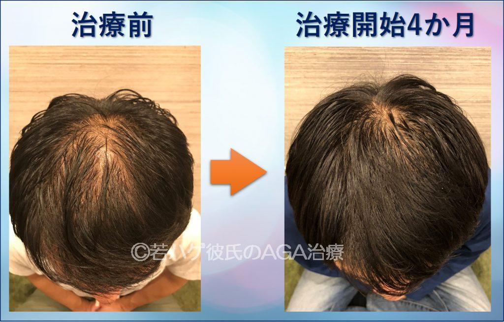 AGA治療4か月目の頭頂部