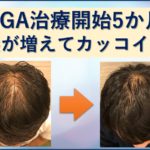 AGA5か月前髪増えた！