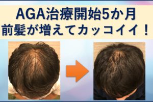 AGA5か月前髪増えた！