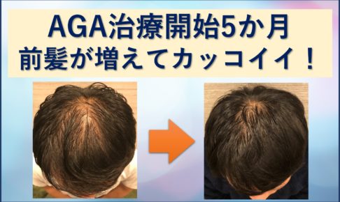 AGA5か月前髪増えた！