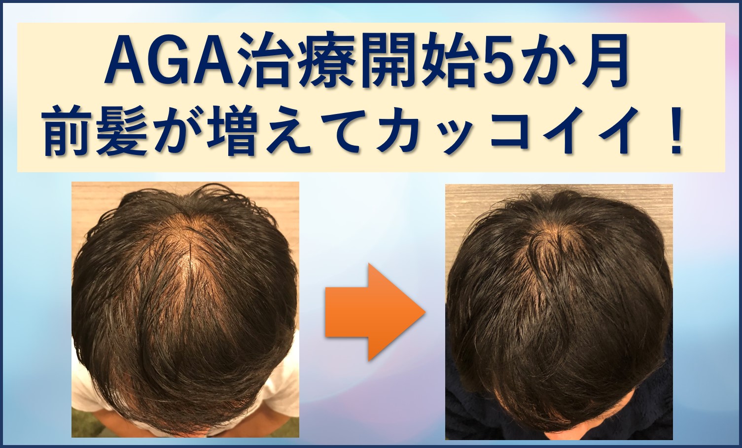 AGA5か月前髪増えた！