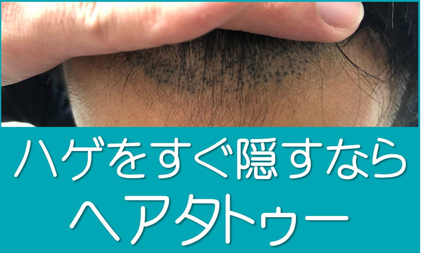 ハゲをすぐ隠すなら短髪よりヘアタトゥー