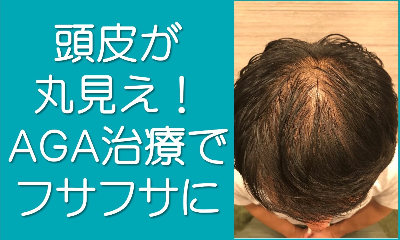 頭皮が丸見え若ハゲだった彼氏がaga治療でフサフサになったお話 若