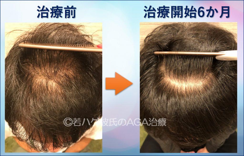 AGA治療6か月間の記録ブログ3