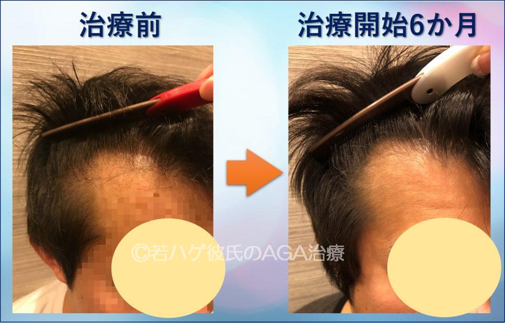 AGA治療6か月間の記録ブログ2