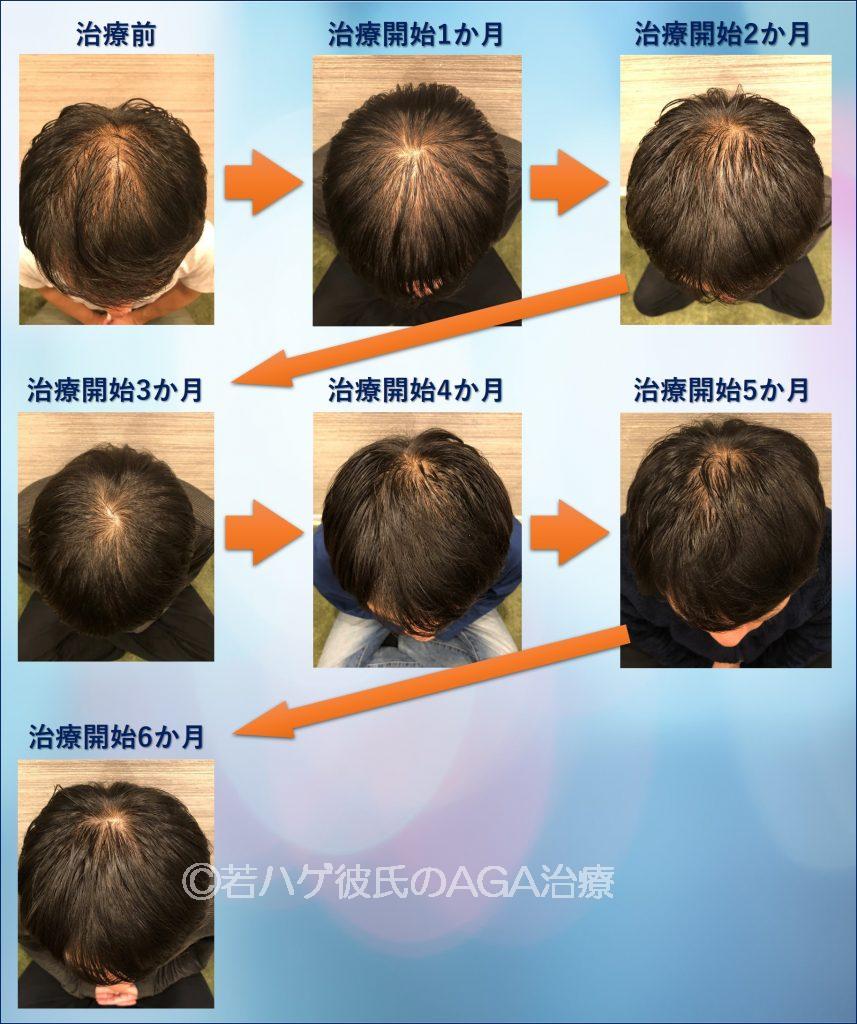 AGA治療6か月間の記録ブログ