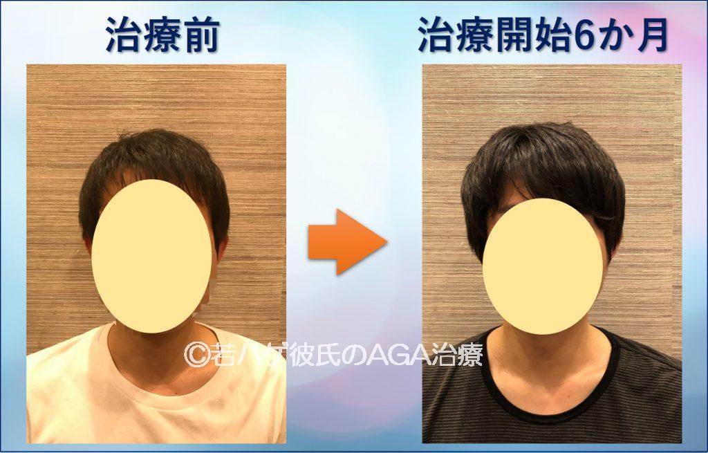 AGA治療6か月間の記録ブログ4