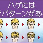 ハゲには進行パターンがある