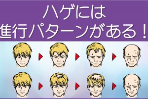 ハゲには進行パターンがある