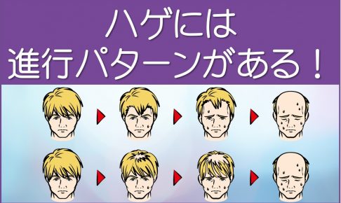ハゲには進行パターンがある