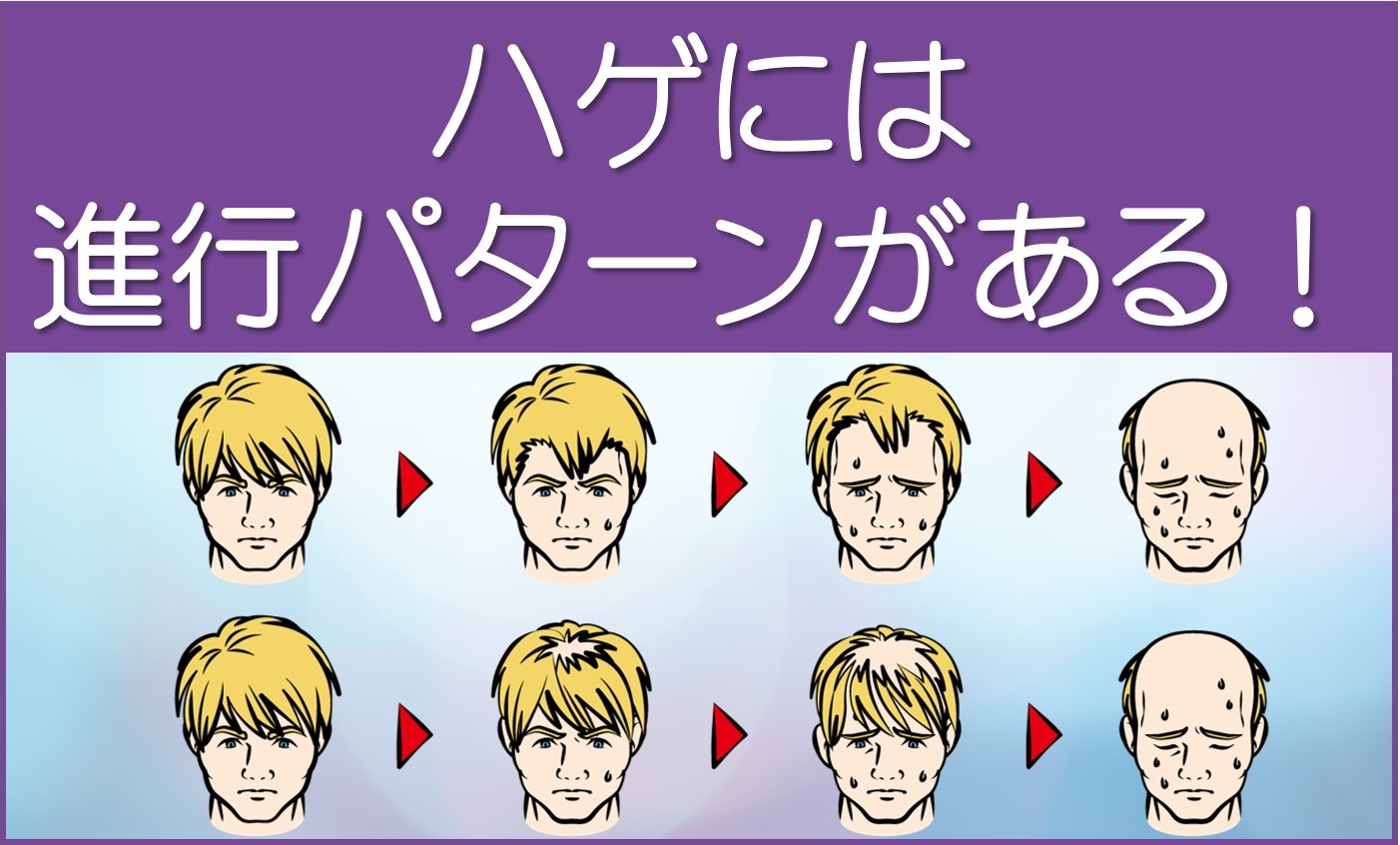ハゲには進行パターンがある