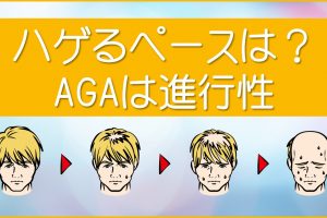 ハゲるペースは？AGAは進行性