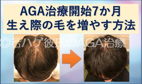 AGA治療7か月目生え際の髪の毛を増やす方法