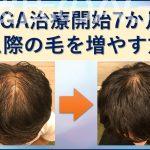 AGA治療7か月目生え際の髪の毛を増やす方法