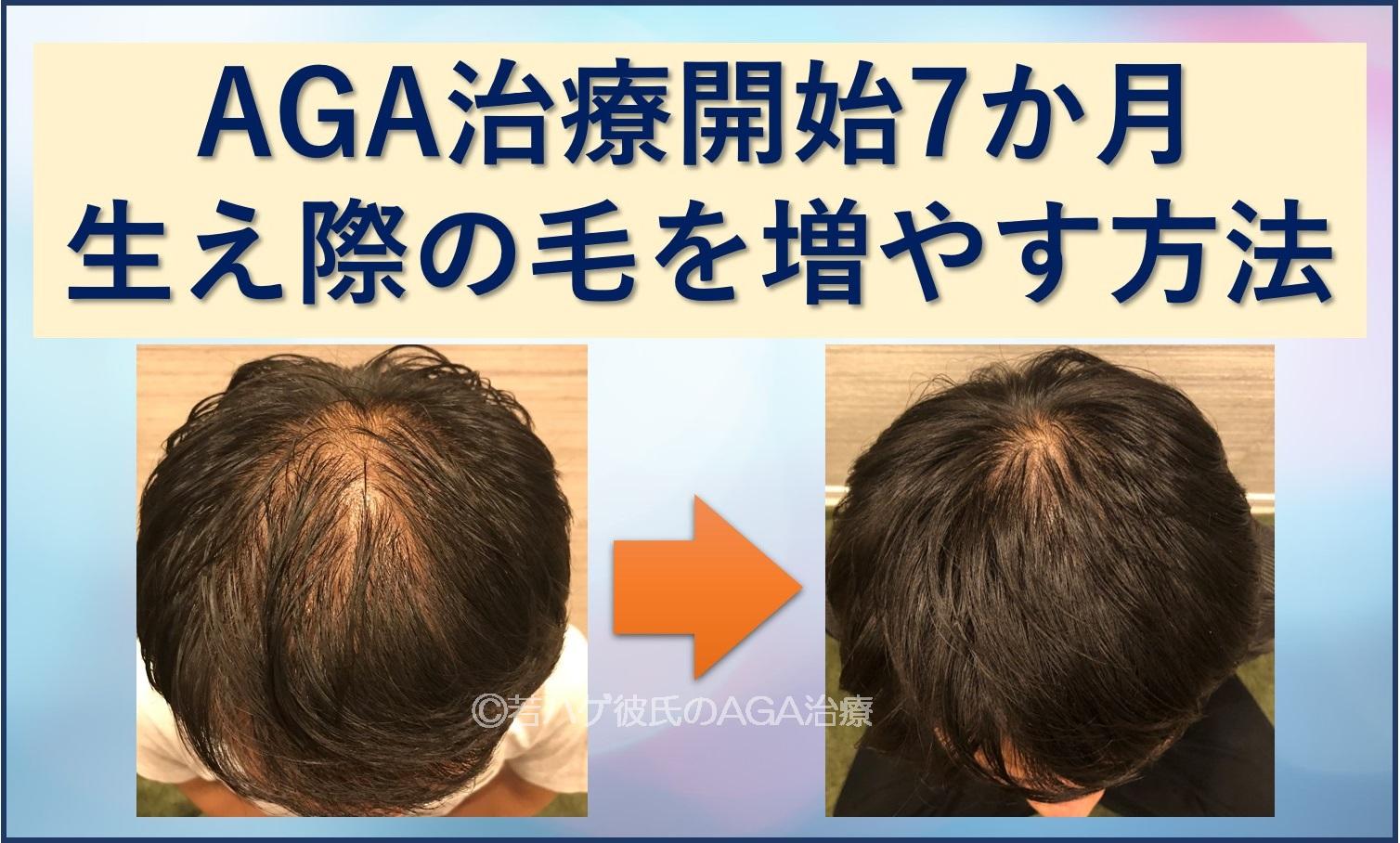 方法 髪の毛 生える