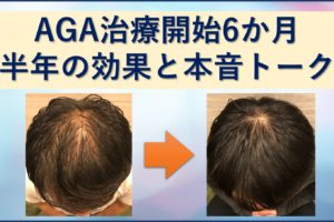 AGA治療半年の効果と本音トークブログ