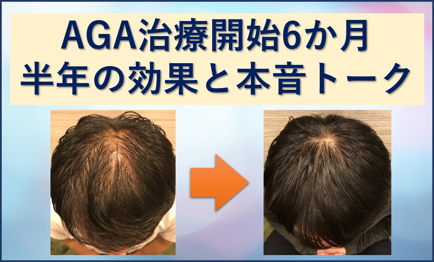 AGA治療半年の効果と本音トークブログ