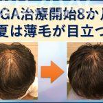 AGA8か月 夏は薄毛が目立つ