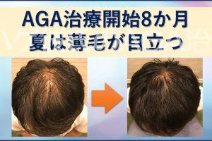 AGA8か月 夏は薄毛が目立つ